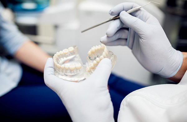 All on4 implant
