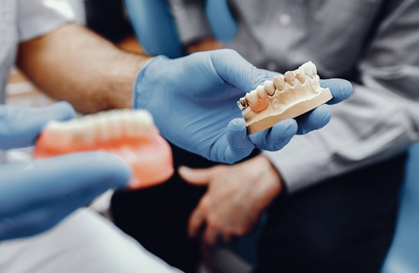 All on6 implant