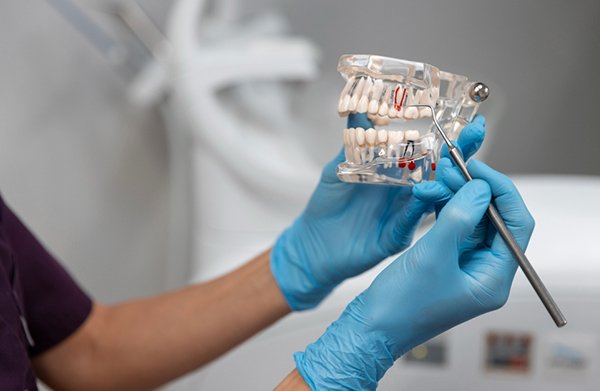  un implant et une prothèse dentaire