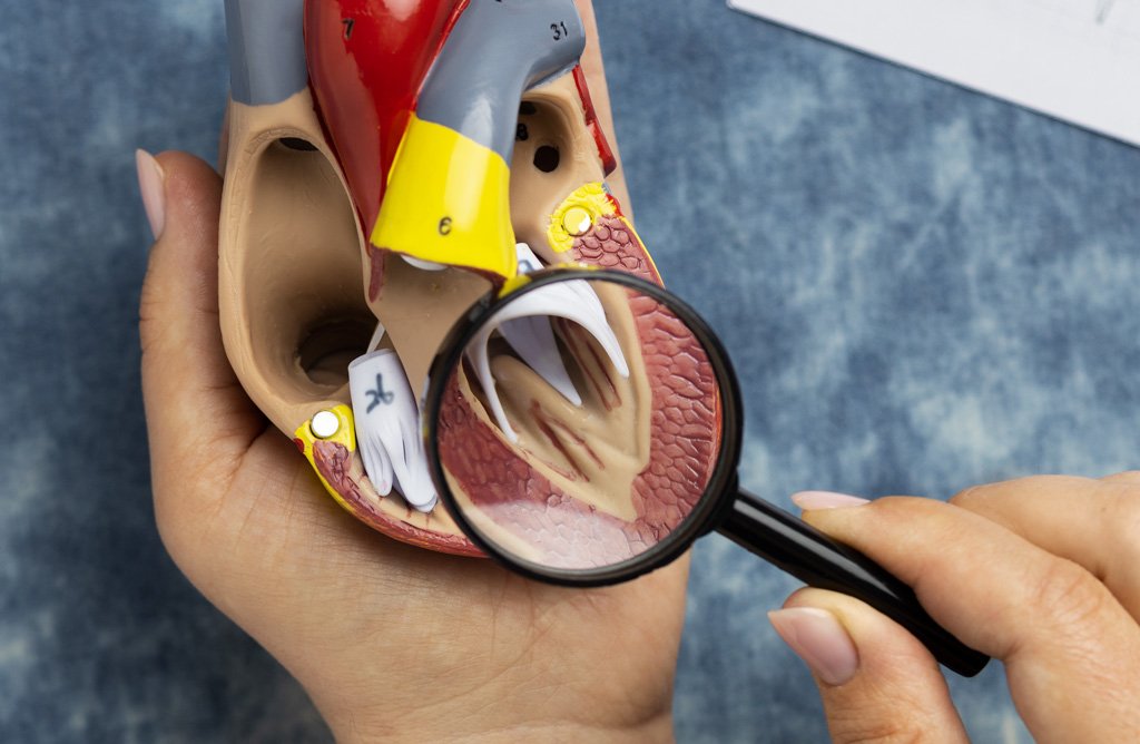 Remplacement valvulaire